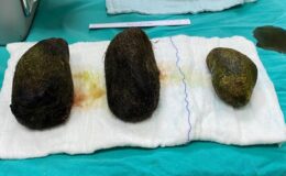 Osmaniye’de karın ağrısı şikayetiyle hastaneye gitti midesinden 2 kilo saç çıktı